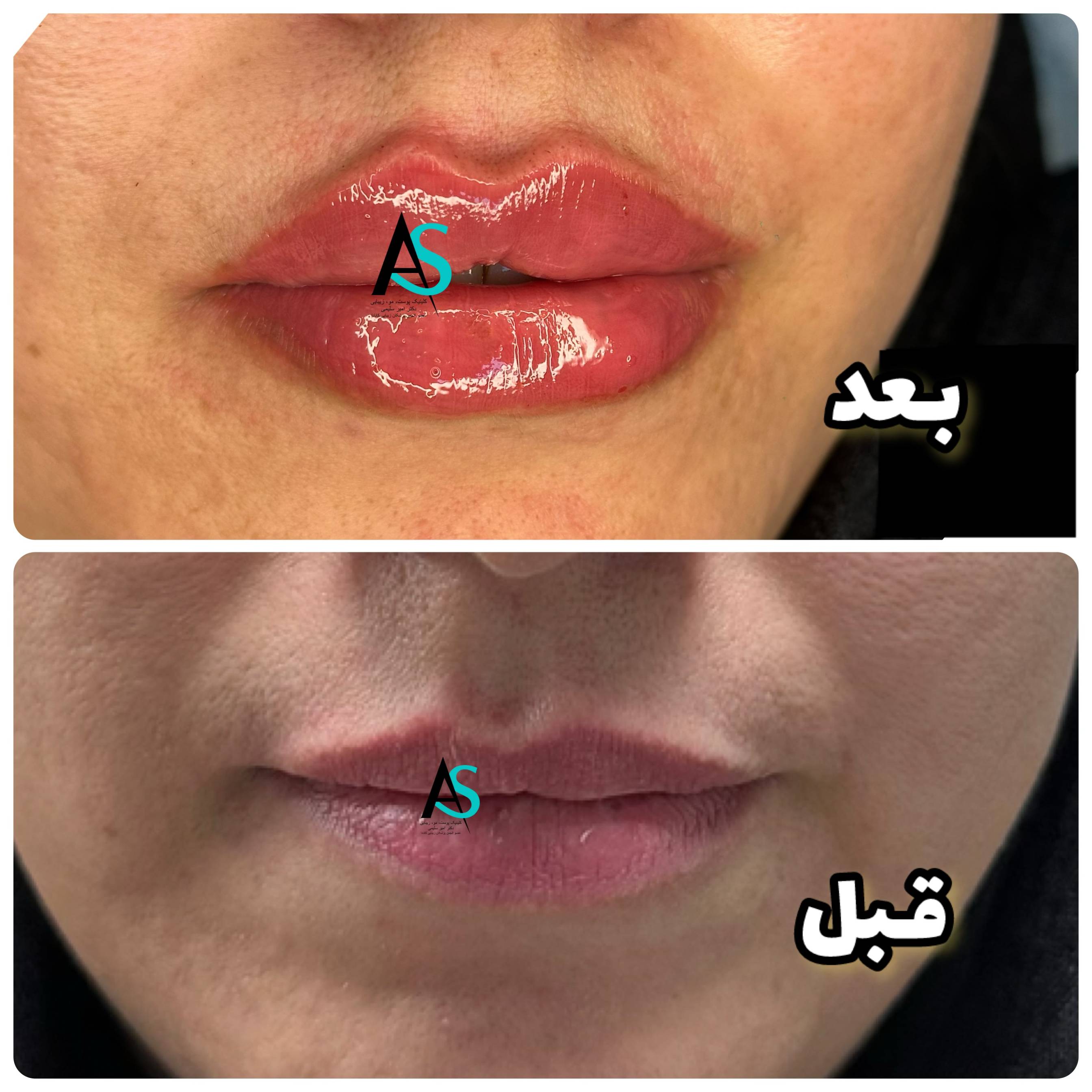 نمونه تزریقات